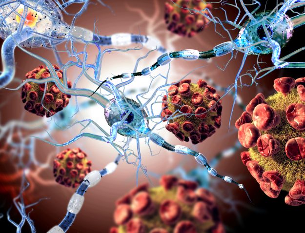Nerve cells. Parkinson's Disease is chronic and progressive.